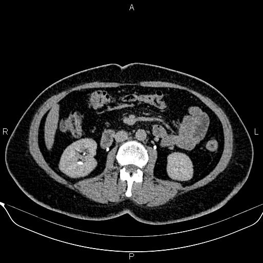Bilateral benign adrenal adenomas (Radiopaedia 86912-103124 Axial C+ delayed 71).jpg