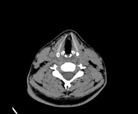 Bilateral carotid body tumors (Radiopaedia 61841-69870 Axial non-contrast 70).jpg