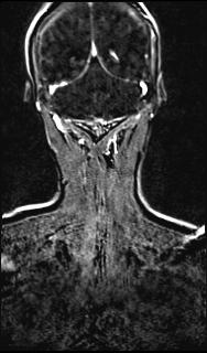 File:Bilateral carotid body tumors and right glomus jugulare tumor (Radiopaedia 20024-20060 MRA 136).jpg