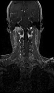 Bilateral carotid body tumors and right glomus jugulare tumor (Radiopaedia 20024-20060 MRA 48).jpg