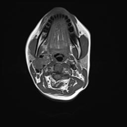 File:Bilateral carotid body tumors and right jugular paraganglioma (Radiopaedia 20024-20060 Axial 7).jpg