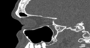 File:Bilateral ectopic infraorbital nerves (Radiopaedia 49006-54084 Sagittal 24).png