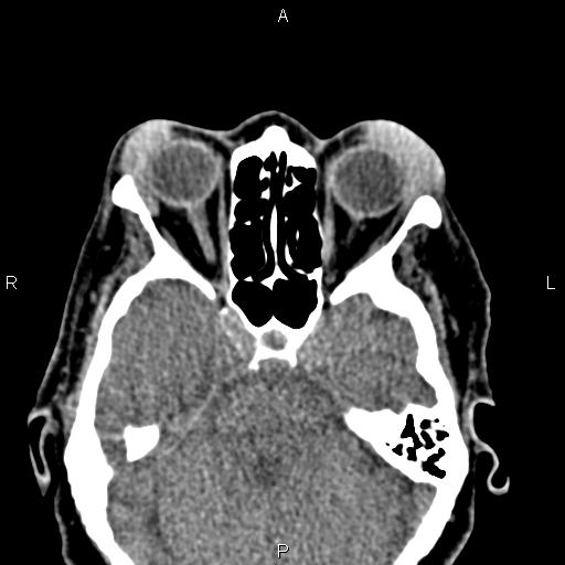 Bilateral enlargement of lacrimal glands - sarcoidosis (Radiopaedia 62627-70921 Axial non-contrast 45).jpg
