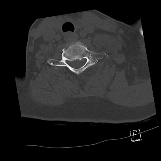 Bilateral occipital condyle fractures (type 3) (Radiopaedia 87672-104086 Axial bone window 61).jpg