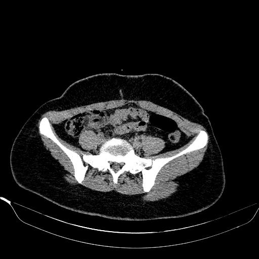 File:Bilateral ovarian dermoid (Radiopaedia 45714-49907 Axial non-contrast 6).JPEG