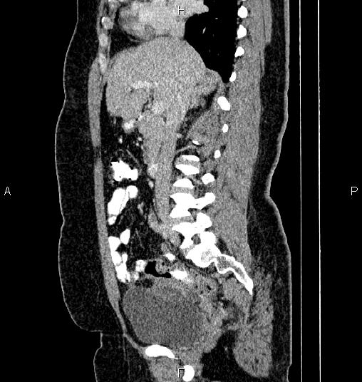 Bilateral ovarian dermoid cysts (Radiopaedia 85785-101603 D 38).jpg