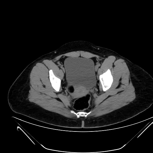 File:Bilateral ovarian mature cystic teratomas (Radiopaedia 79373-92457 Axial non-contrast 72).jpg