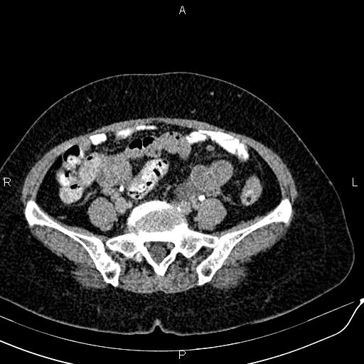 Bilateral ovarian serous cystadenocarcinoma (Radiopaedia 86062-101989 Axial C+ delayed 53).jpg