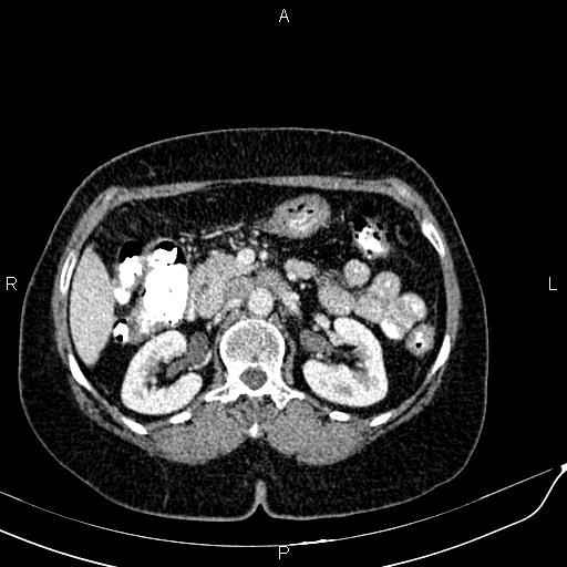 Bilateral ovarian serous cystadenocarcinoma (Radiopaedia 86062-101989 B 38).jpg
