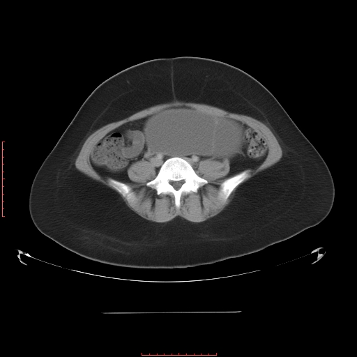 File:Bilateral ovarian serous cystadenocarcinoma with right ovarian torsion (Radiopaedia 32640-33611 A 28).jpg