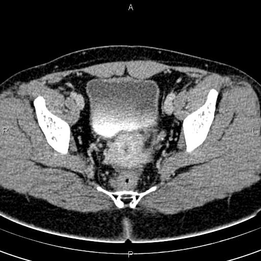File:Bilateral ovarian teratoma (Radiopaedia 83131-97503 B 51).jpg