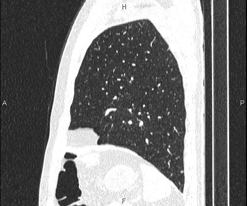 Bilateral pulmonary AVM (Radiopaedia 83134-97505 Sagittal lung window 87).jpg