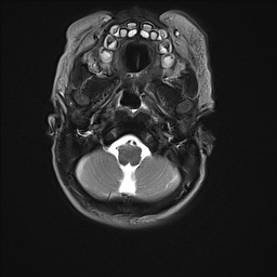 File:Bilateral subdural hemorrhage and parietal skull fracture (Radiopaedia 26058-26190 Axial T2 5).png