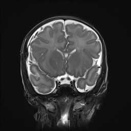 File:Bilateral subdural hemorrhage and parietal skull fracture (Radiopaedia 26058-26190 Coronal T2 11).png