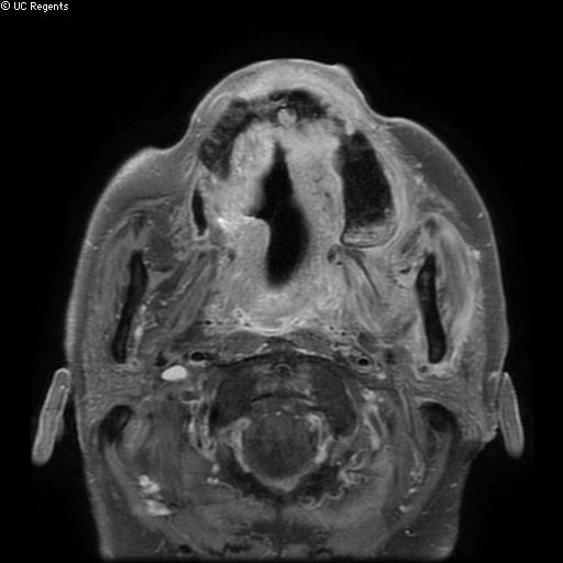 Bisphosphonate-related osteonecrosis of the maxilla (Radiopaedia 51367-57101 Axial T1 C+ fat sat 19).jpg