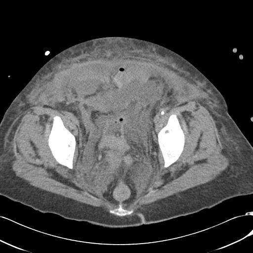 Bladder rupture post renal biopsy (Radiopaedia 30863-31572 Axial non-contrast 77).jpg
