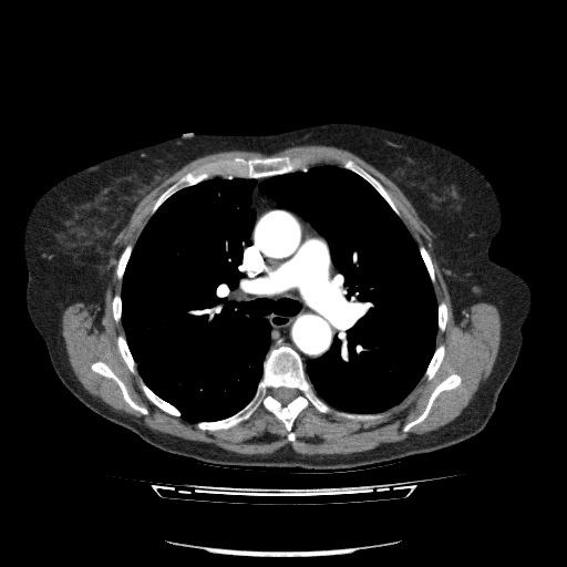 File:Bladder tumor detected on trauma CT (Radiopaedia 51809-57609 A 43).jpg