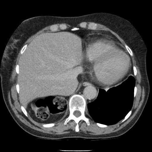 Bladder tumor detected on trauma CT (Radiopaedia 51809-57609 C 21).jpg