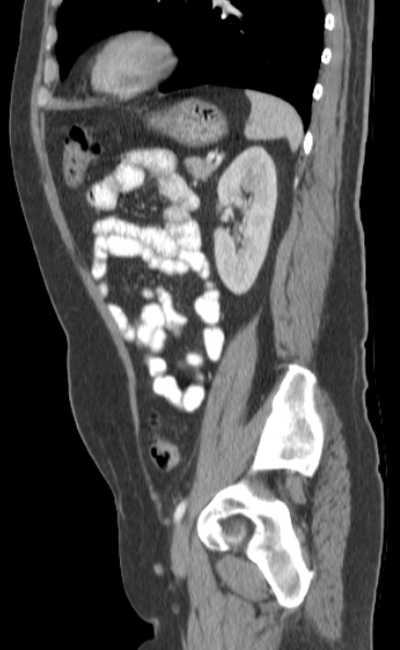 Bleeding duodenal ulcer and adenomyomatosis of gallbladder (Radiopaedia 61834-69861 C 72).jpg