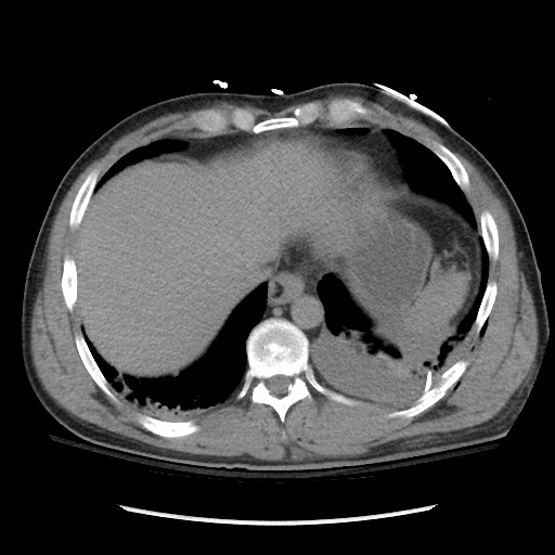 Blunt abdominal trauma with solid organ and musculoskelatal injury with active extravasation (Radiopaedia 68364-77895 Axial C+ delayed 19).jpg