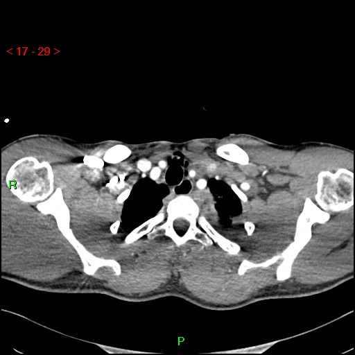 Blunt thoracic trauma (Radiopaedia 73454-84221 Axial soft tissues 11).jpg