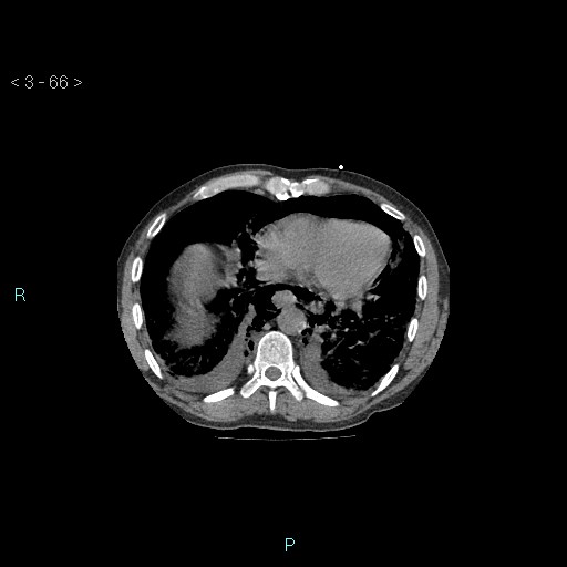 Boerhaave syndrome (Radiopaedia 27683-27897 Axial non-contrast 66).jpg