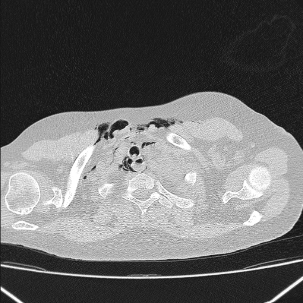 Boerhaave syndrome (Radiopaedia 45644-49799 Axial lung window 28).jpg