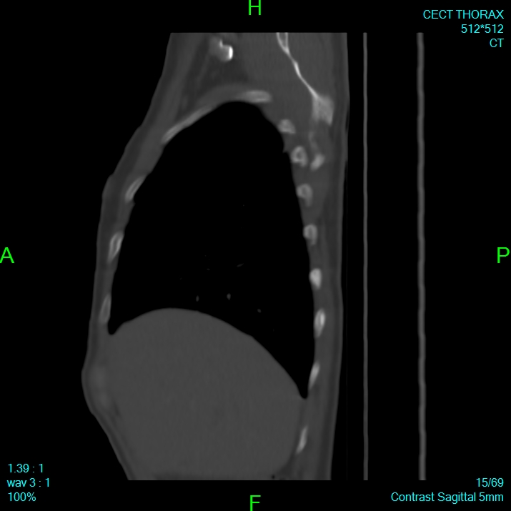 Bone metastases from lung carcinoma (Radiopaedia 54703-60937 Sagittal bone window 15).jpg