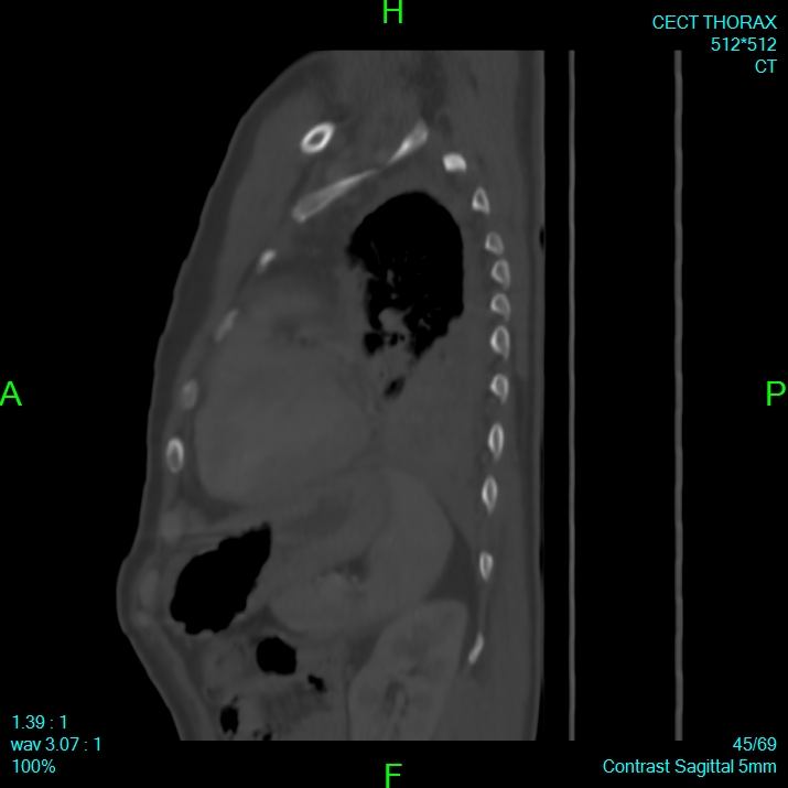 Bone metastases from lung carcinoma (Radiopaedia 54703-60937 Sagittal bone window 45).jpg