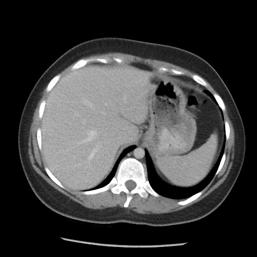 File:Borderline mucinous tumor (ovary) (Radiopaedia 78228-90808 A 69).jpg