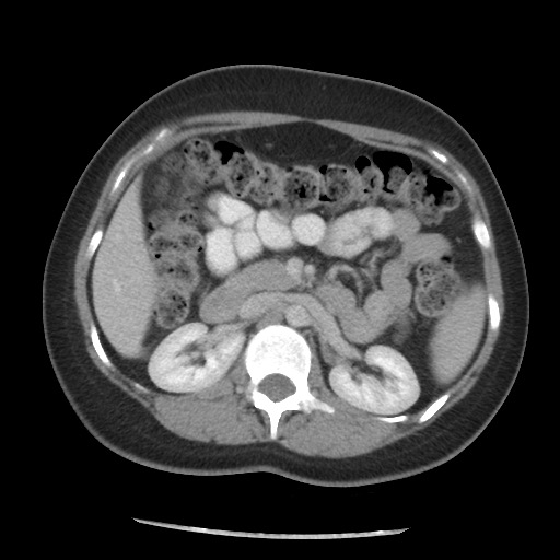 File:Borderline mucinous tumor (ovary) (Radiopaedia 78228-90808 A 82).jpg