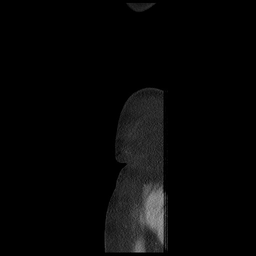 File:Borderline mucinous tumor (ovary) (Radiopaedia 78228-90808 B 5).jpg