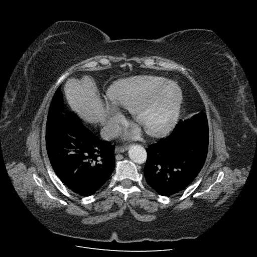 Bovine aortic arch - right internal mammary vein drains into the superior vena cava (Radiopaedia 63296-71875 A 108).jpg