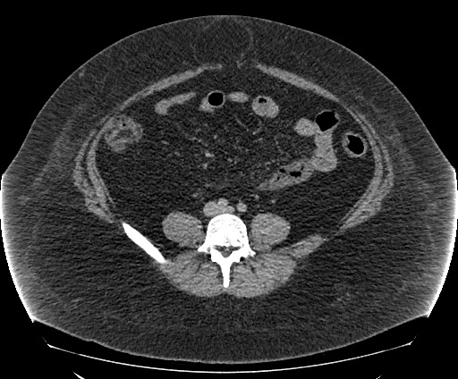 Bowel and splenic infarcts in acute lymphocytic leukemia (Radiopaedia 61055-68913 A 82).jpg