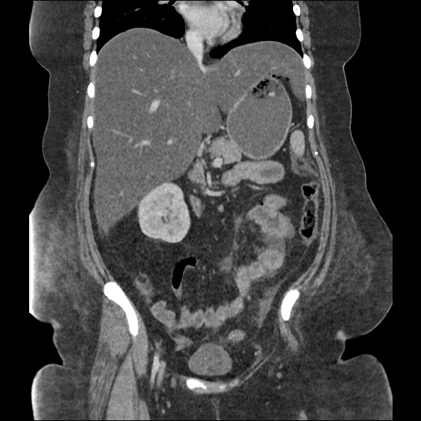 Bowel and splenic infarcts in acute lymphocytic leukemia (Radiopaedia 61055-68915 B 31).jpg