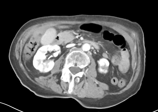 File:Bowel ischemia (Radiopaedia 58273-65382 A 26).png