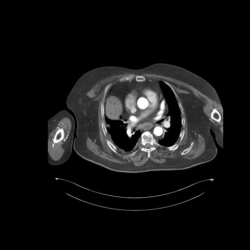 File:Bowel ischemia secondary to SMA occlusion with extensive portomesenteric venous gas (Radiopaedia 54656-60871 A 81).jpg