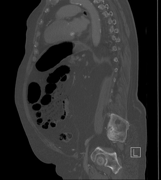 Bowel ischemia secondary to SMA occlusion with extensive portomesenteric venous gas (Radiopaedia 54656-60871 Sagittal bone window 40).jpg