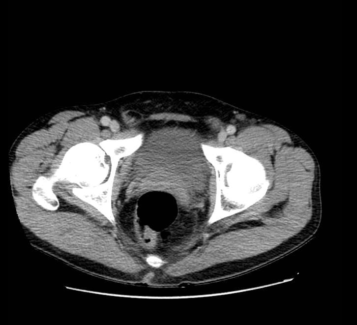 Bowel obstruction from colon carcinoma (Radiopaedia 22995-23028 A 82).jpg