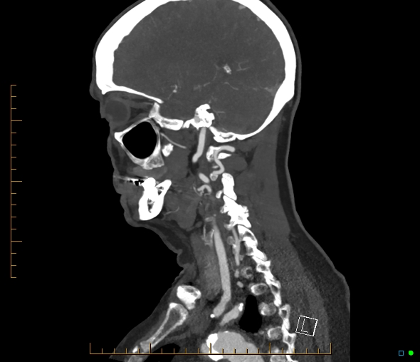 Brachiocephalic trunk stenosis (Radiopaedia 87242-103519 C 22).jpg