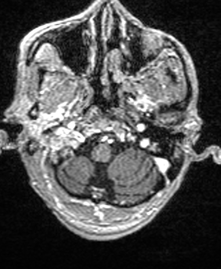 Brain abscess with dual rim sign (Radiopaedia 87566-103938 Axial T1 C+ 29).jpg