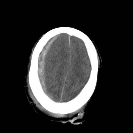File:Brain death after motor vehicle collision (Radiopaedia 88470-105114 Axial 20).png