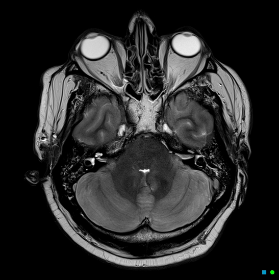 File:Brain death on MRI and CT angiography (Radiopaedia 42560-45689 Axial T2 10).jpg