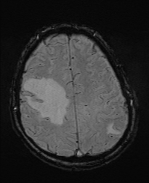 Brain metastases - lung cancer primary (Radiopaedia 75060-86115 Axial SWI 45).jpg
