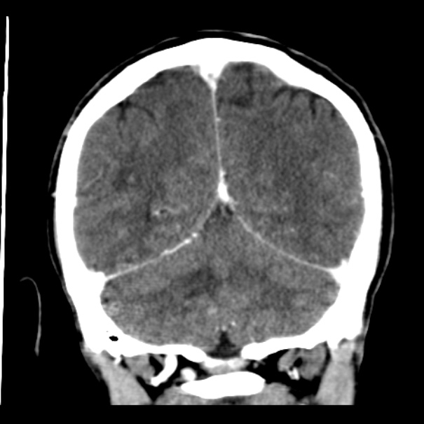 Brain metastases from lung cancer (Radiopaedia 24480-24781 Coronal C+ delayed 47).jpg
