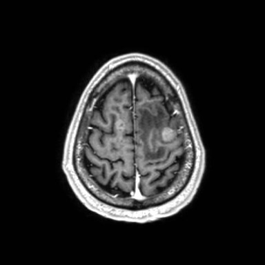 Brain metastases from lung cancer (Radiopaedia 83839-99028 Axial T1 C+ 59).jpg