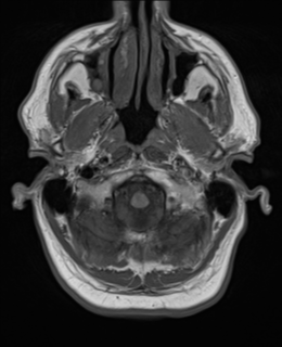 File:Brain metastasis (large cystic mass) (Radiopaedia 47497-52107 Axial T1 2).png