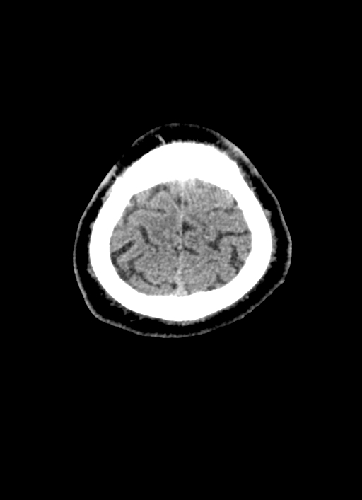 Brainstem hemorrhage (Radiopaedia 81294-94976 Axial non-contrast 9).jpg