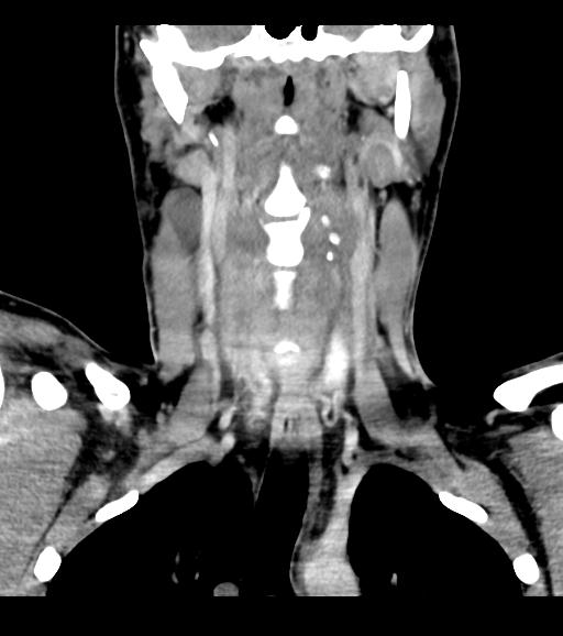 File:Branchial cleft cyst (Radiopaedia 31167-31875 Coronal C+ delayed 35).jpg