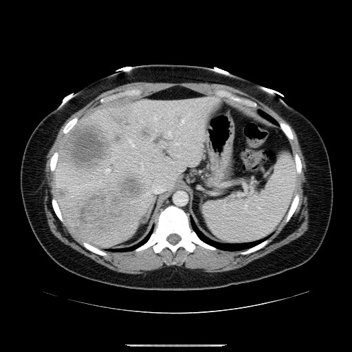 File:Breast cancer pseudocirrhosis after chemotherapy (Radiopaedia 65407-74456 A 21).jpg